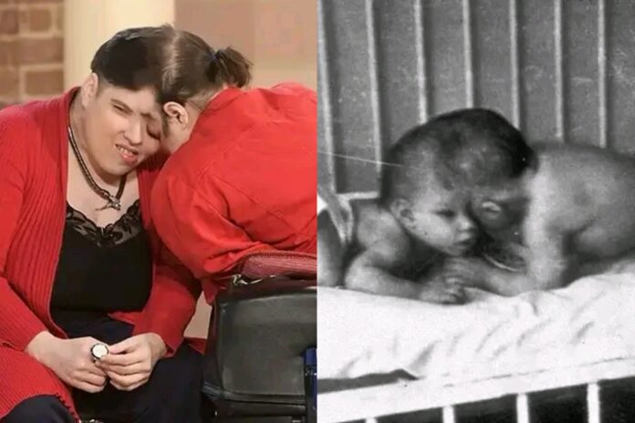 Conjoined Twins, Lori and George schappell