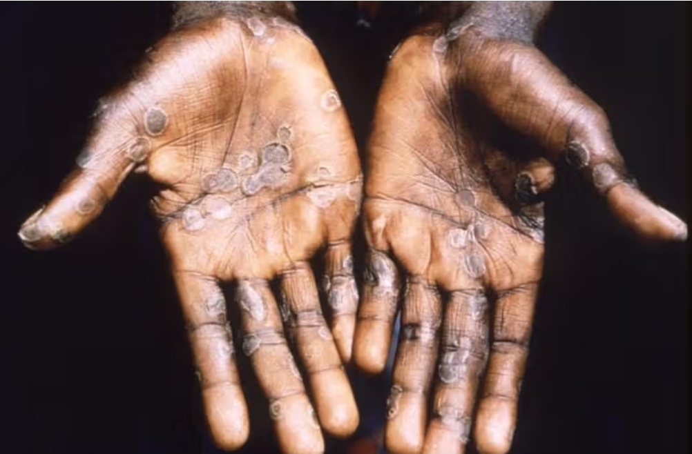 The palms of a monkeypox patient in the Democratic Republic of Congo.Centers for Disease Control and Prevention