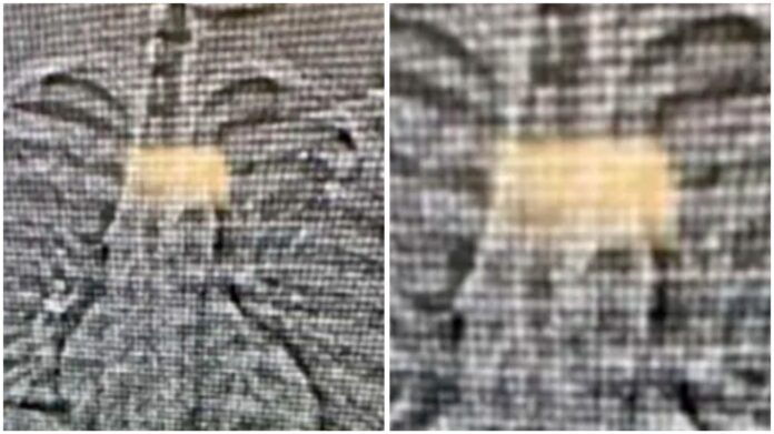 An Orlando Police Department image showing what appears to be a pair of diamond earrings swallowed by a suspect.  Orlando Police Department/AP